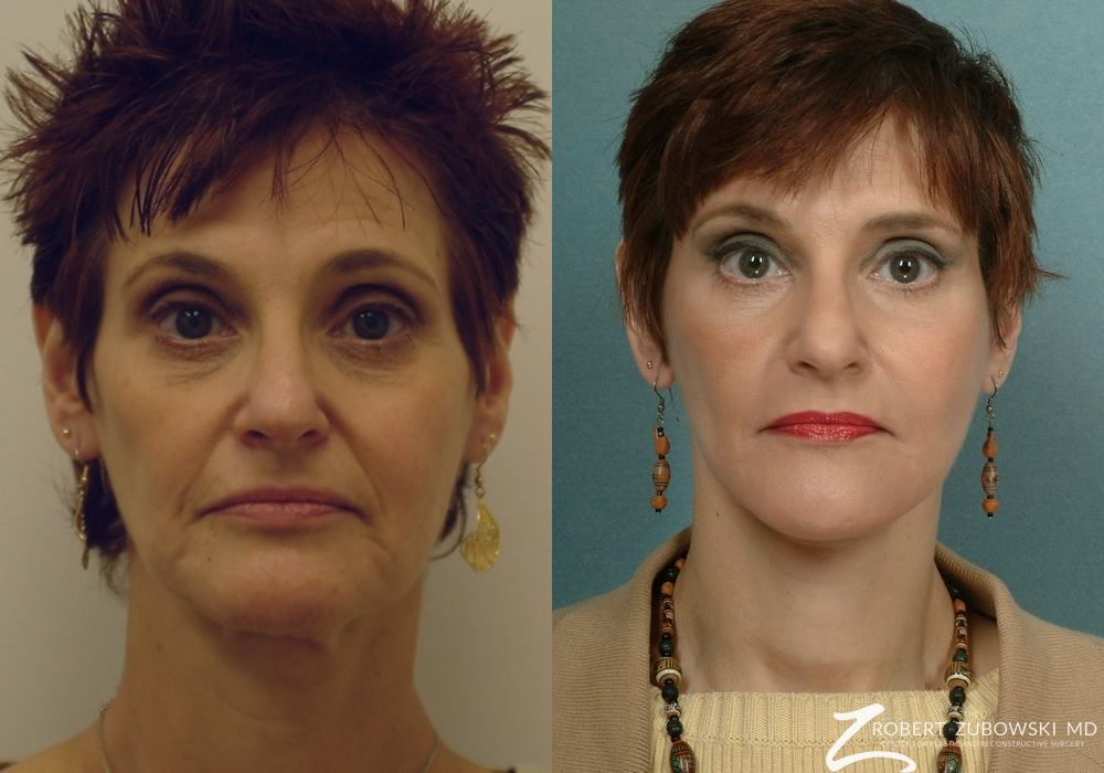 Before and after procedure result