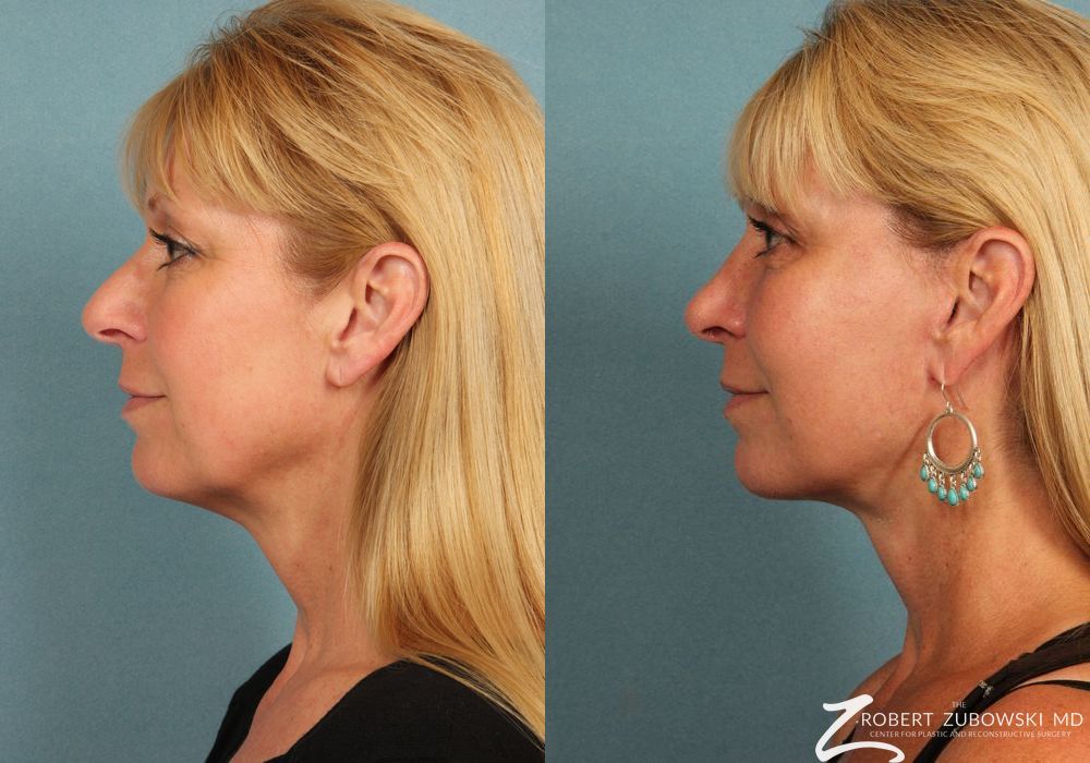 Facelift - Thumbnail 2