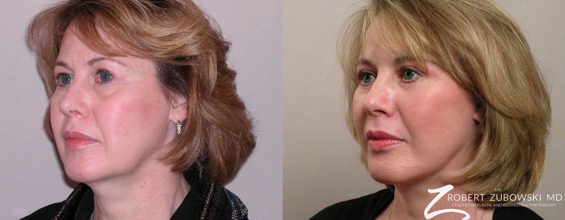 Facelift - Thumbnail 2