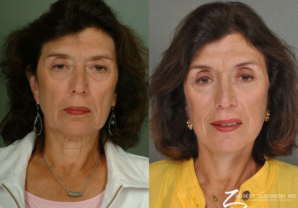 Facelift - Case 3806