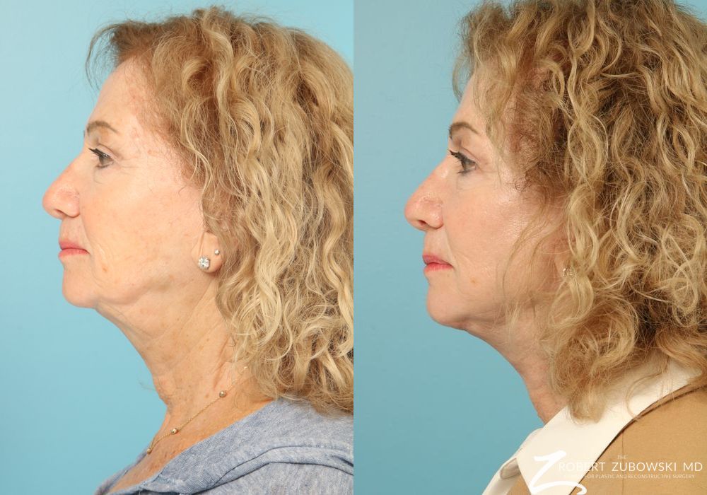 Facelift - Thumbnail 2