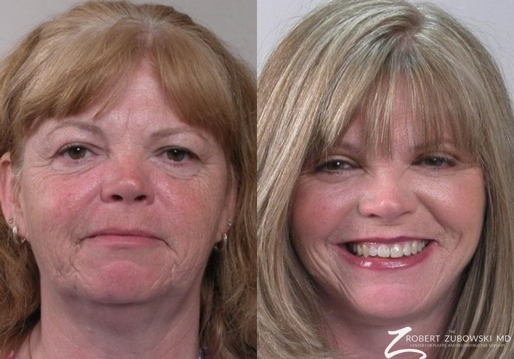 Before and after procedure result