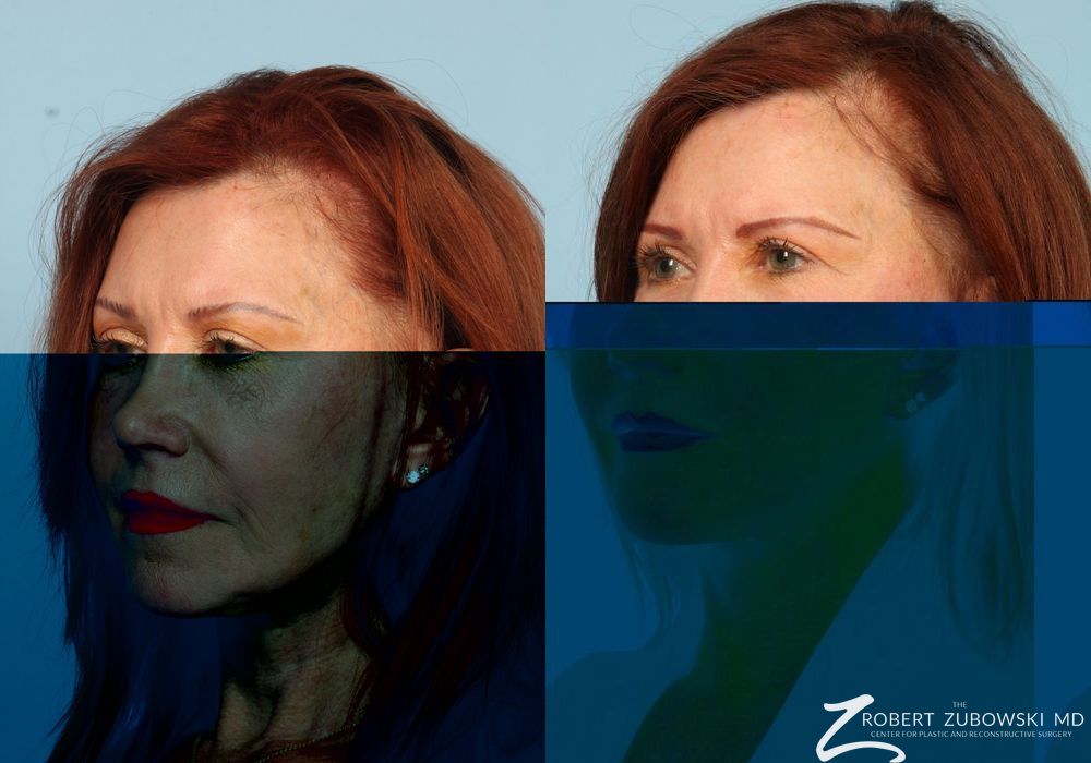 Facelift - Thumbnail 3