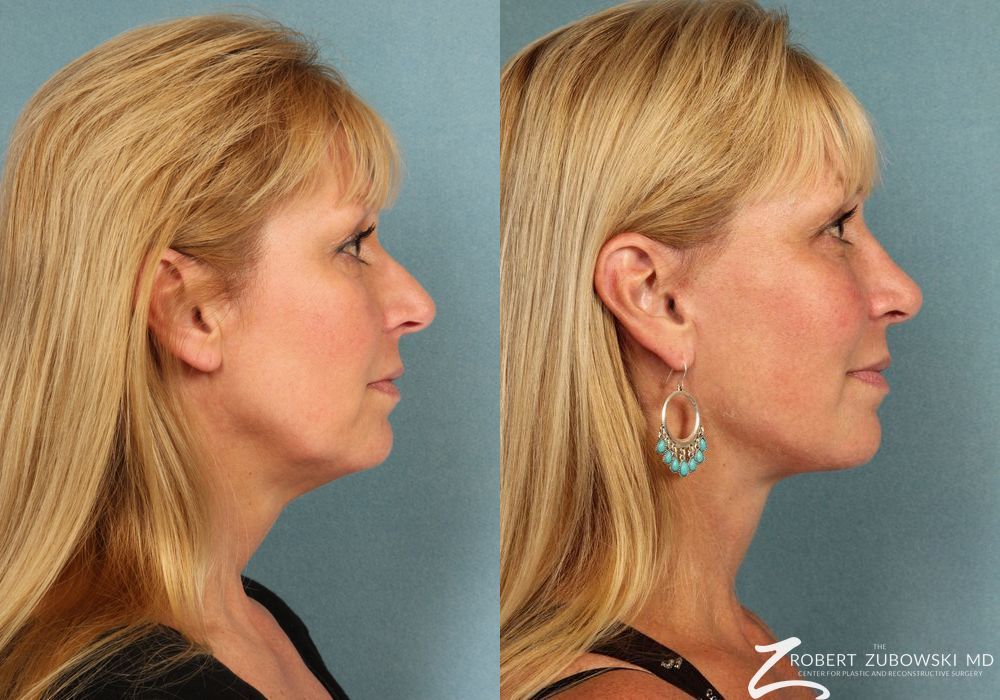 Facelift - Thumbnail 3