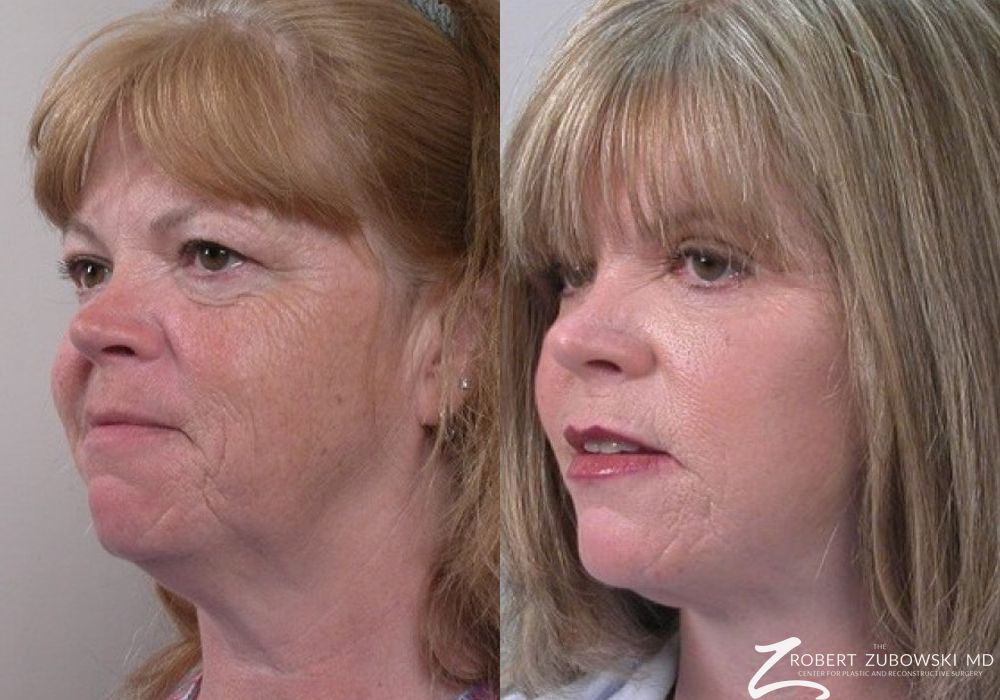 Facelift - Thumbnail 2