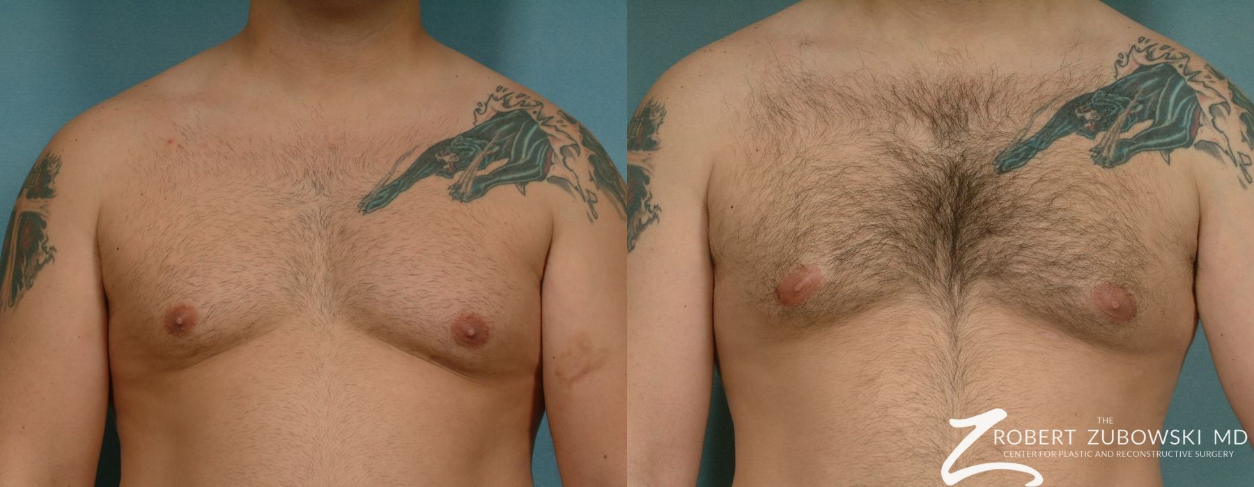 Gynecomastia - Case 4181