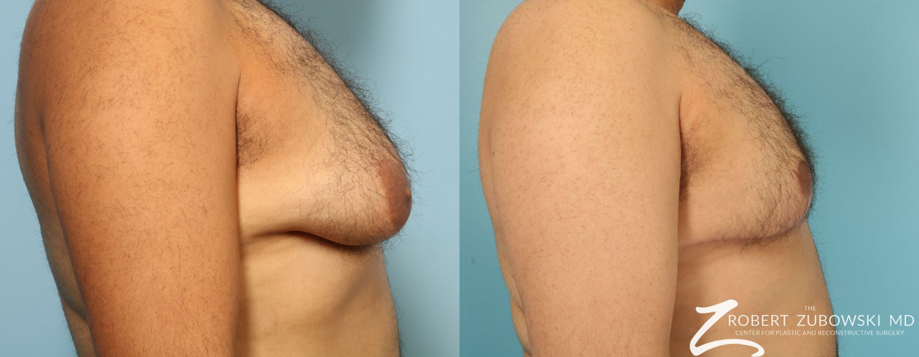 Gynecomastia - Thumbnail 2