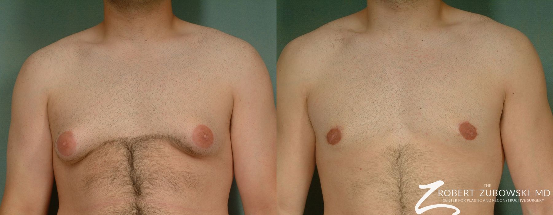 Gynecomastia - Thumbnail 2