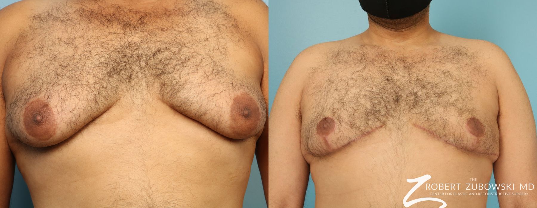Gynecomastia - Case 3734