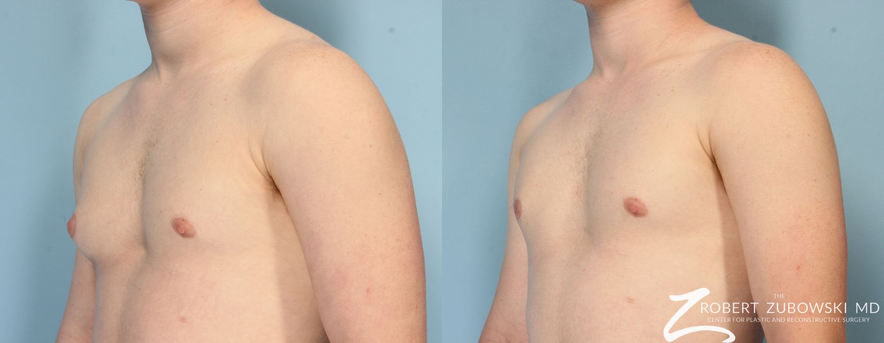 Gynecomastia - Thumbnail 3