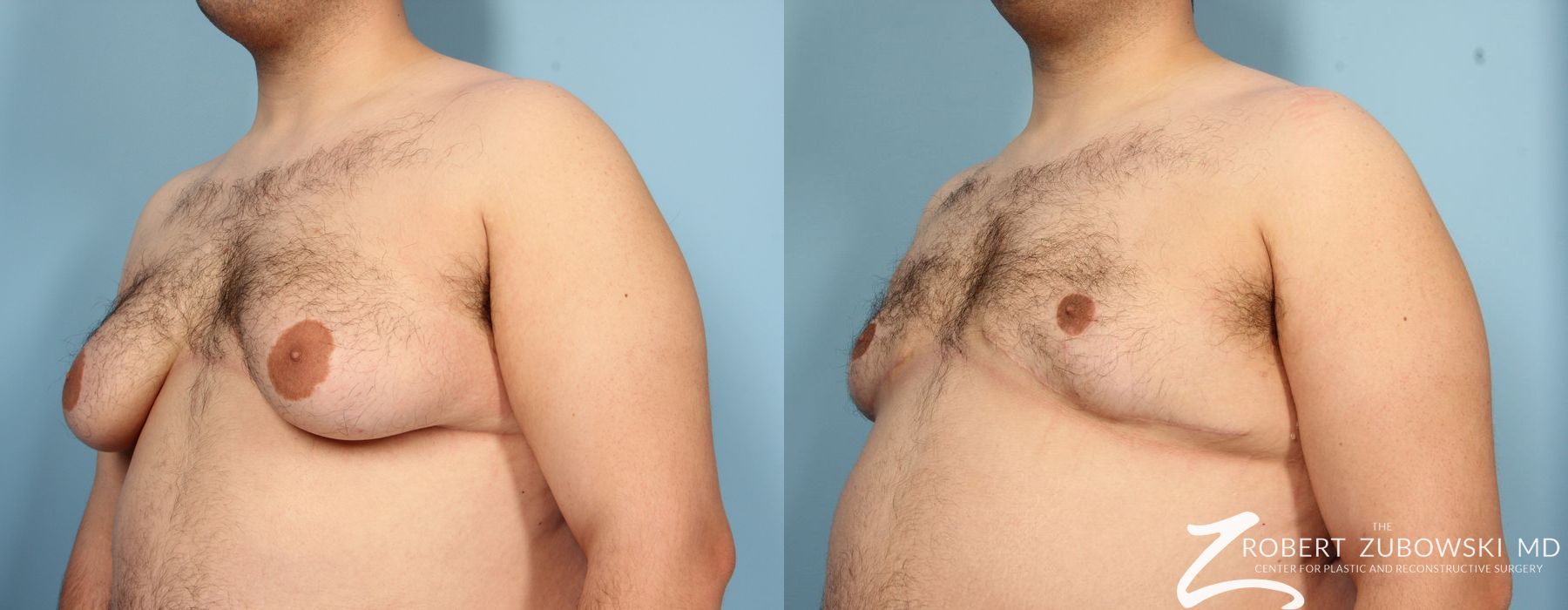Gynecomastia - Thumbnail 2