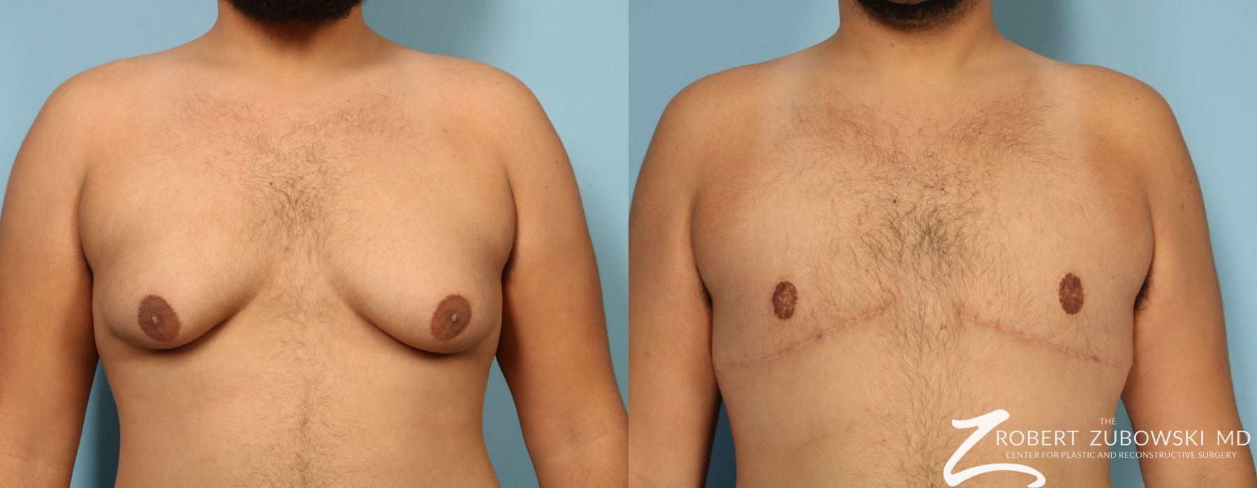 Gynecomastia - Case 3733