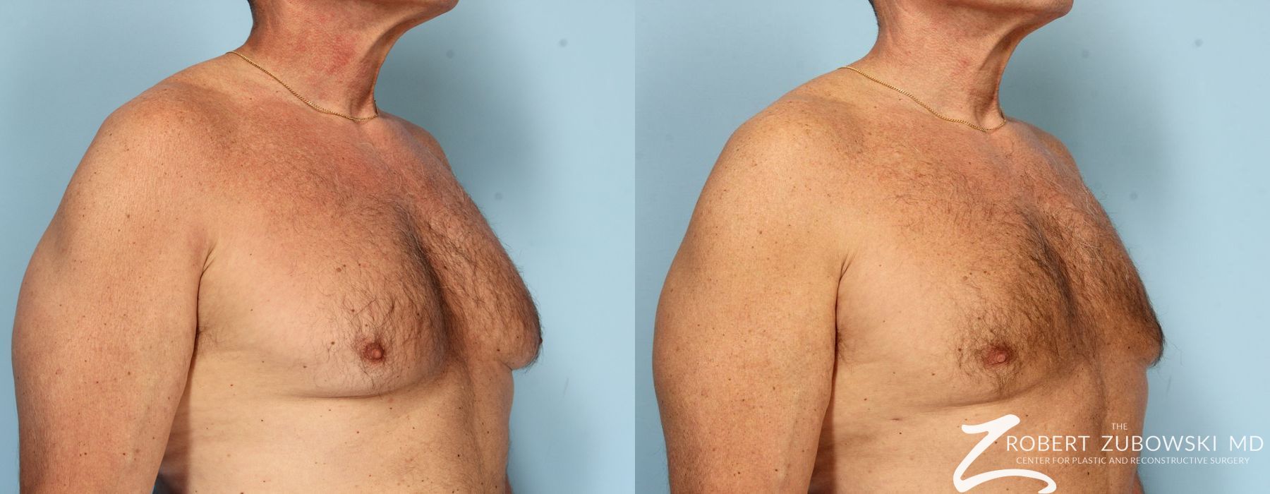Gynecomastia - Thumbnail 2