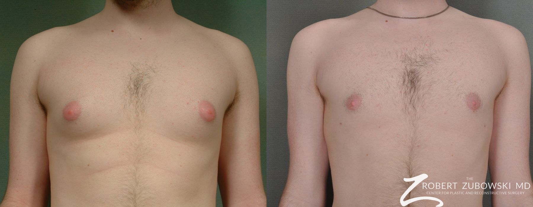 Gynecomastia - Case 3727