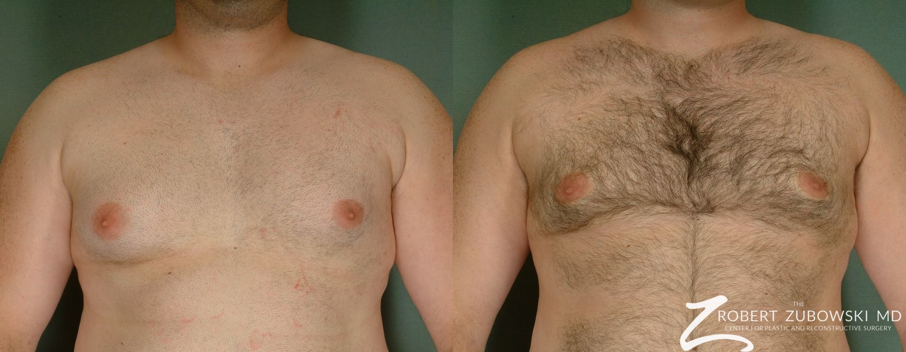 Gynecomastia - Case 3724