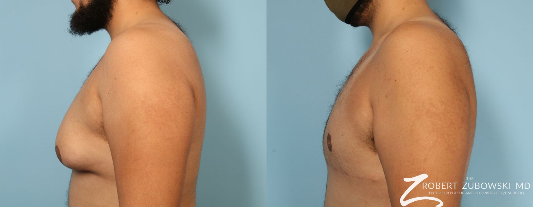 Gynecomastia - Thumbnail 2