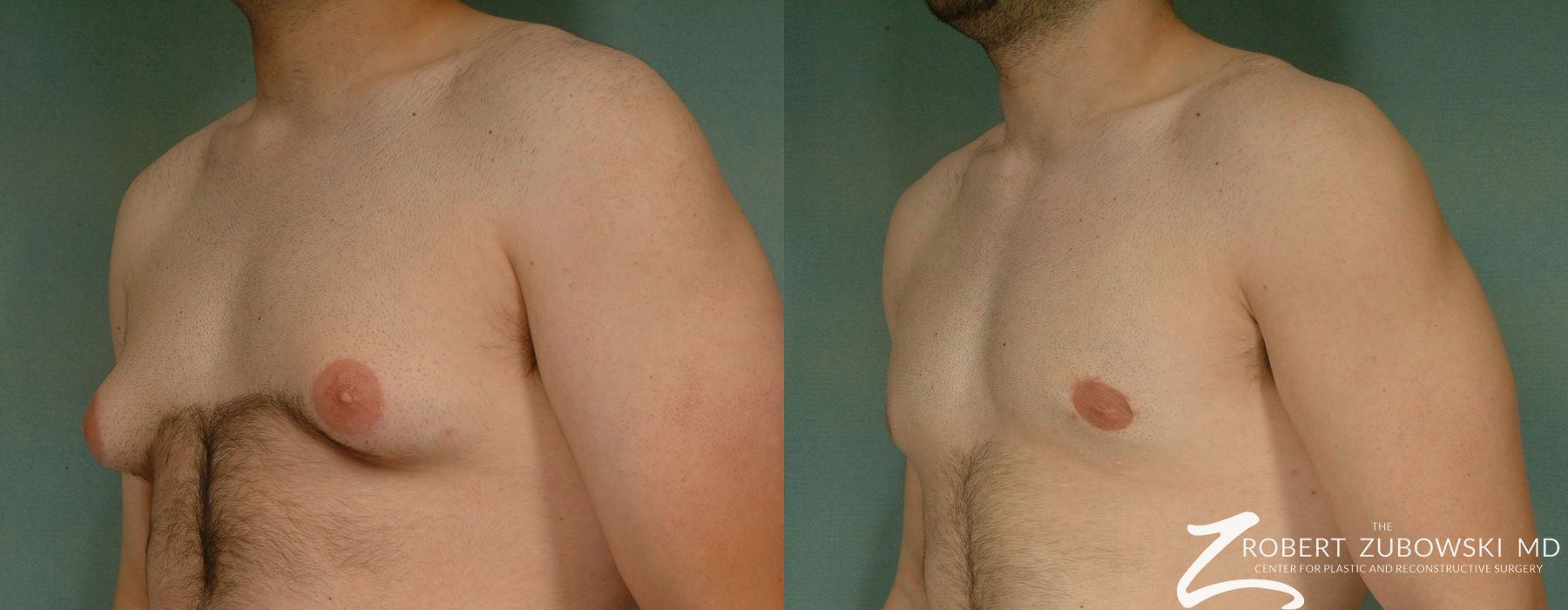Gynecomastia - Case 3722