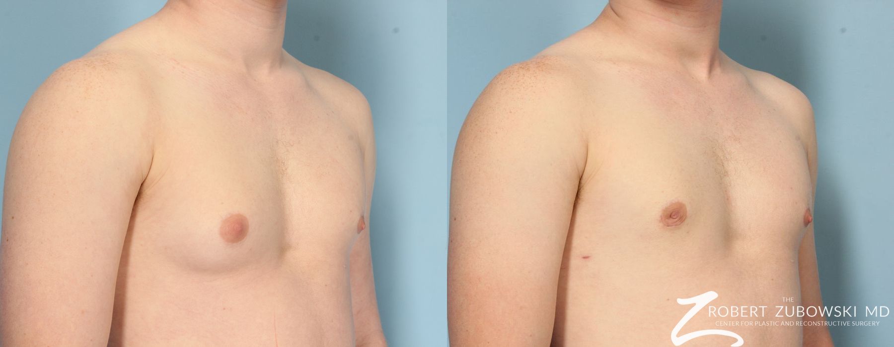 Gynecomastia - Thumbnail 2