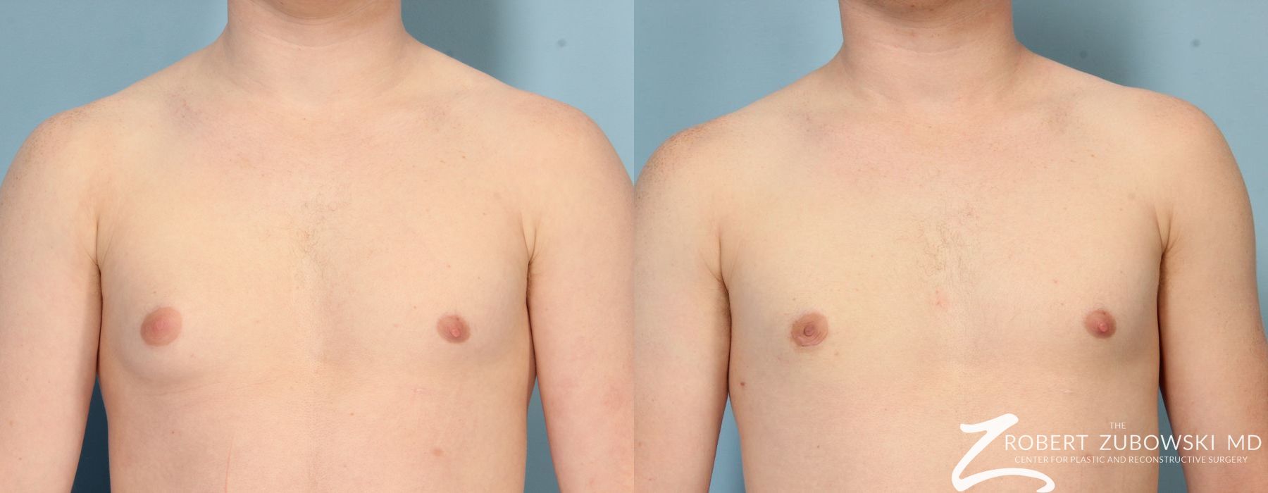 Gynecomastia - Case 4180
