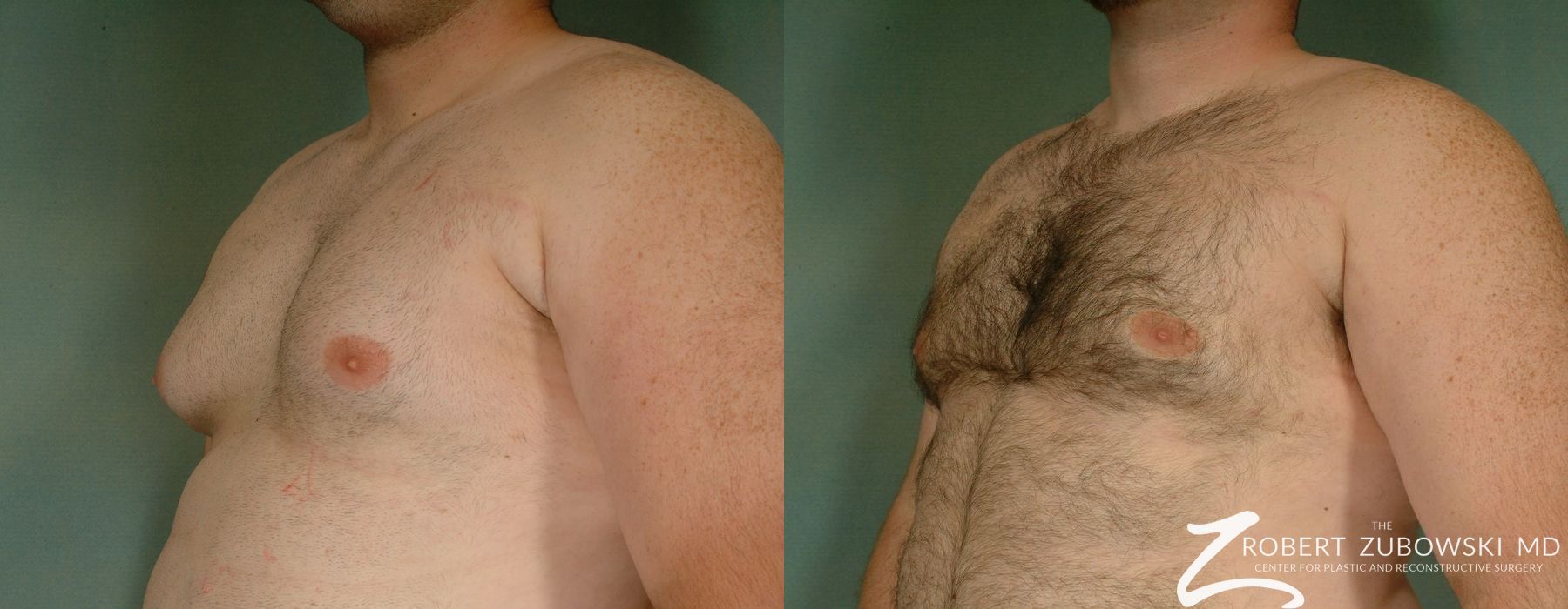 Gynecomastia - Thumbnail 2