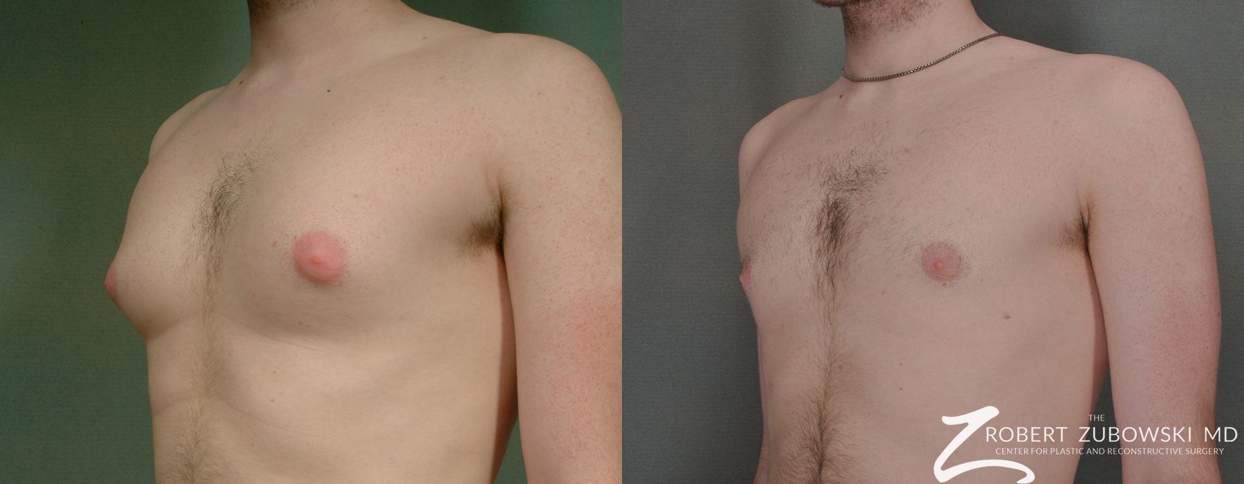 Gynecomastia - Thumbnail 2
