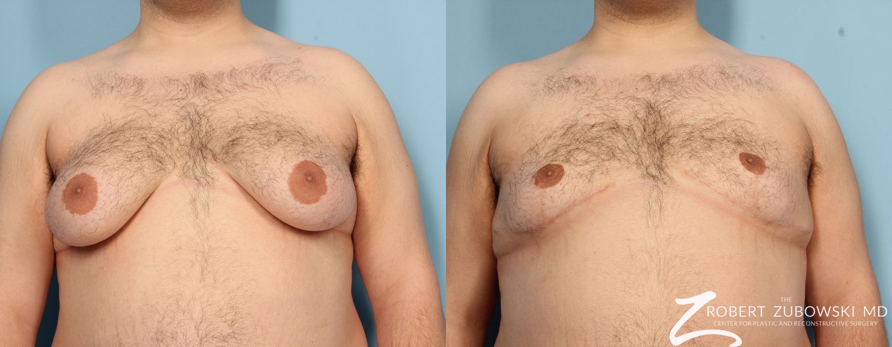 Gynecomastia - Case 3721