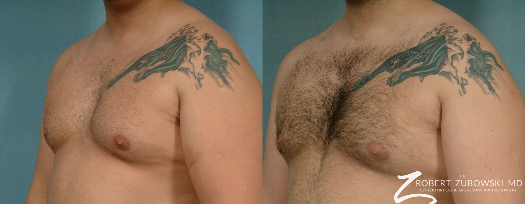 Gynecomastia - Thumbnail 2