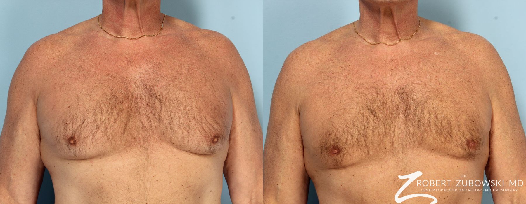 Gynecomastia - Case 3732