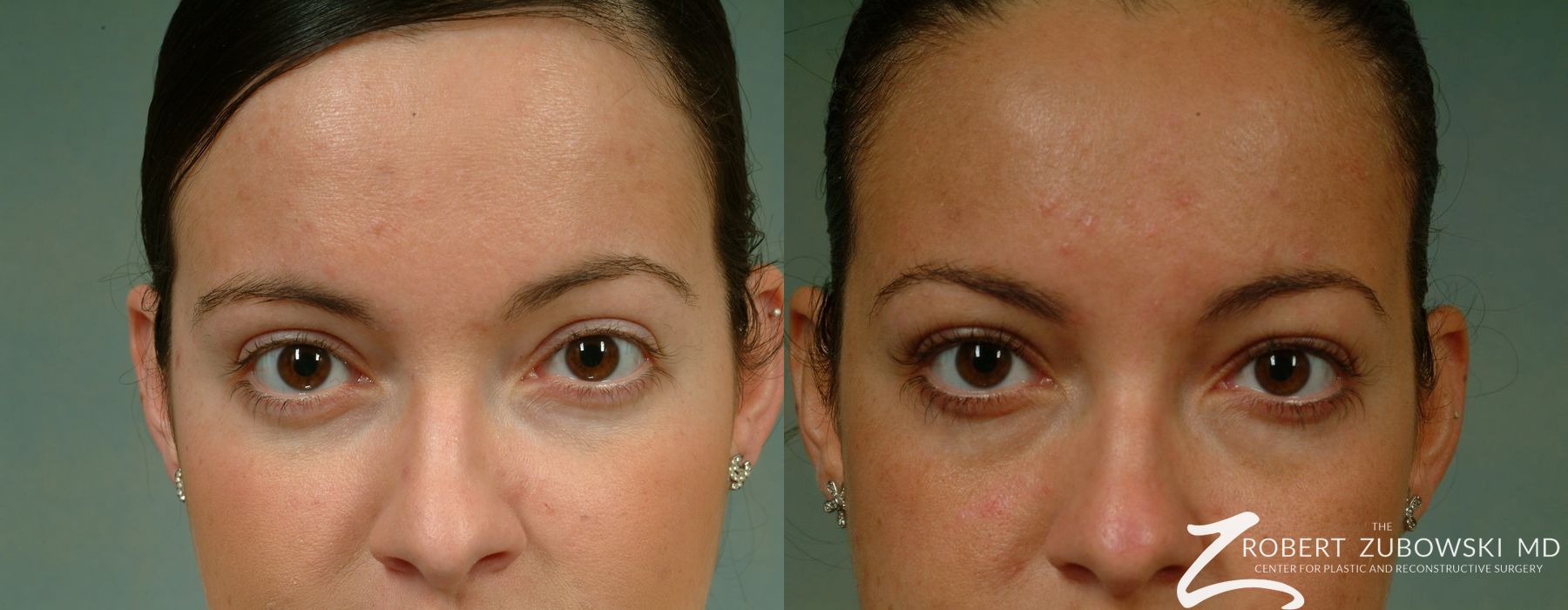 Before and after Latisse case 8213 - Angle 2