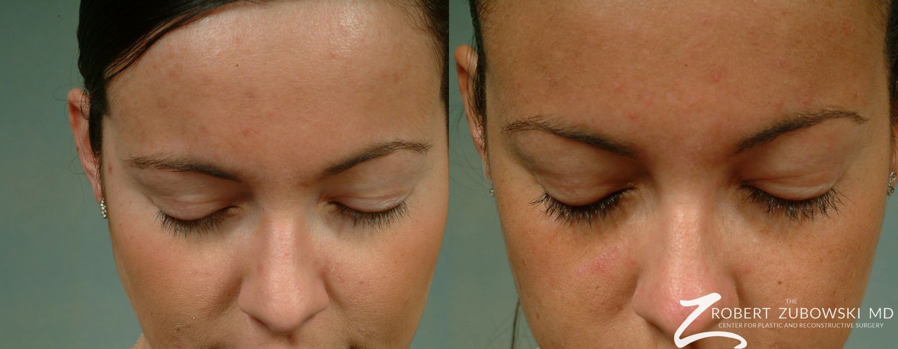 Before and after Latisse case 8213