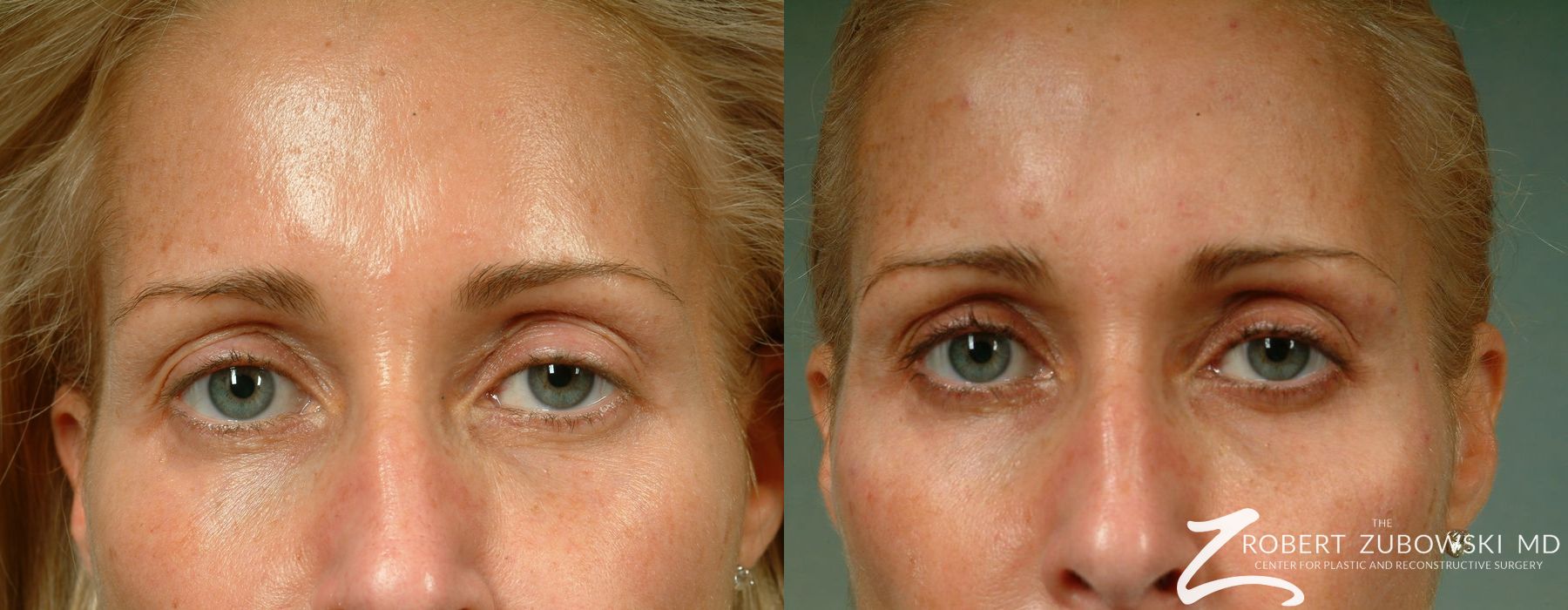 Before and after Latisse case 8184 - Angle 2