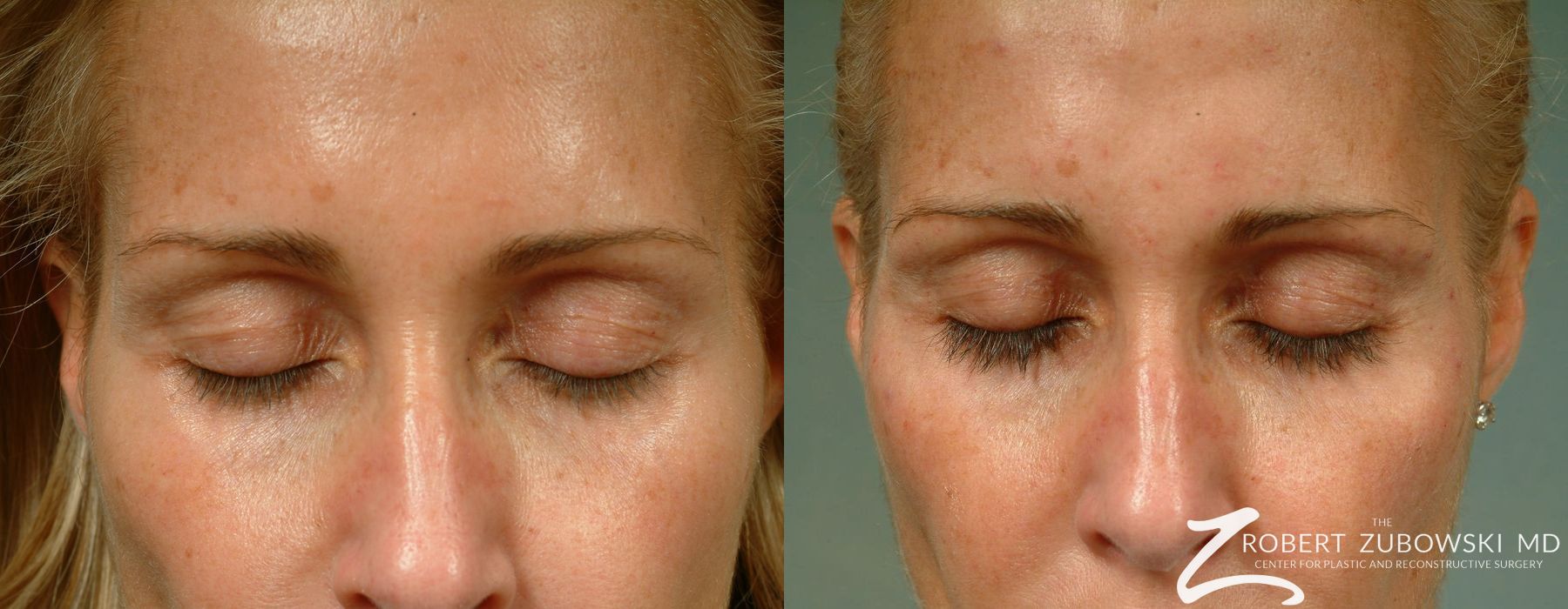 Before and after Latisse case 8184