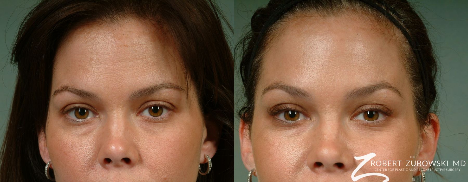 Latisse - Thumbnail 2