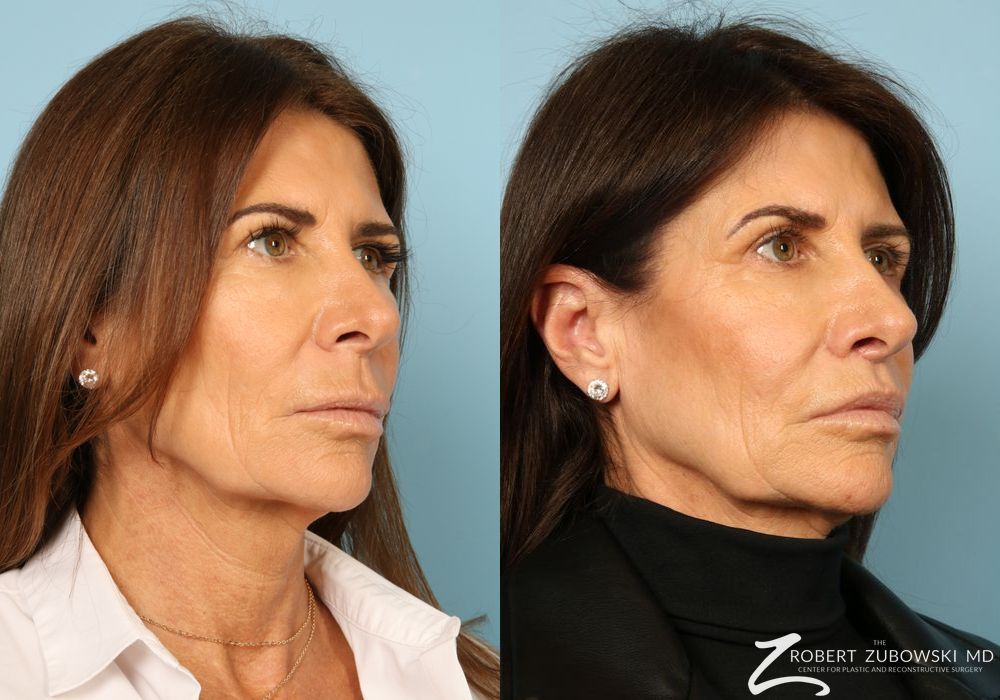 Before and after Lip Augmentation case 8563 - Angle 3