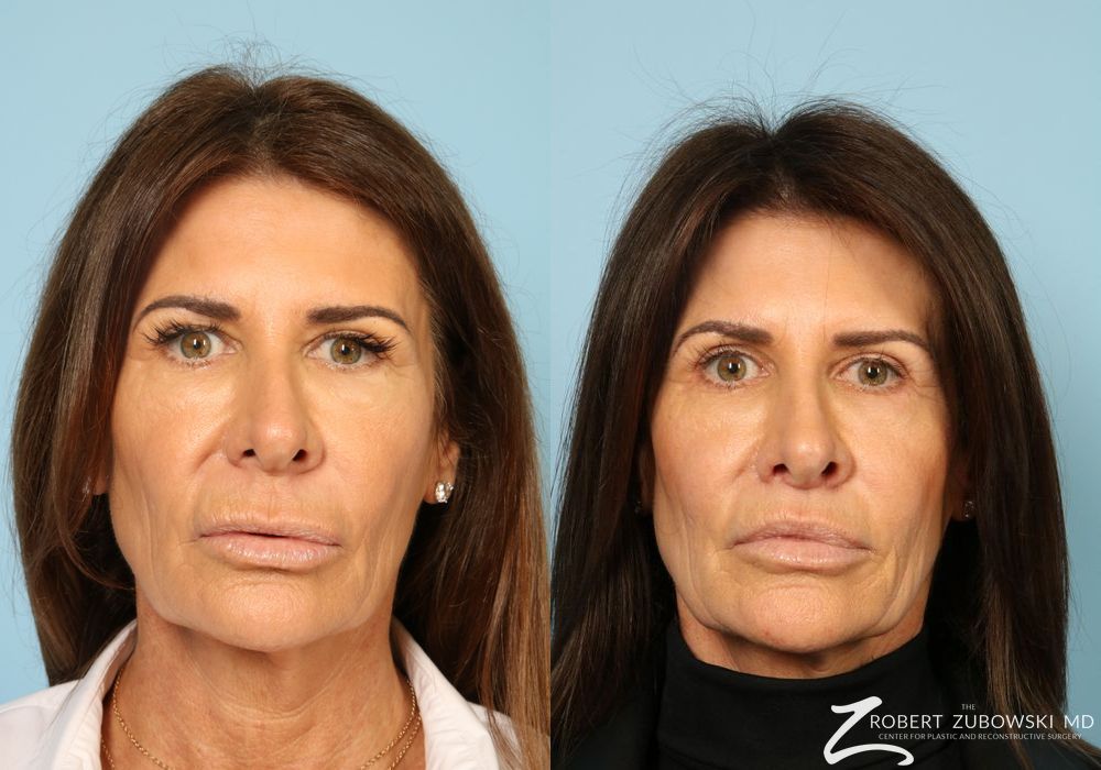 Before and after Lip Augmentation case 8563