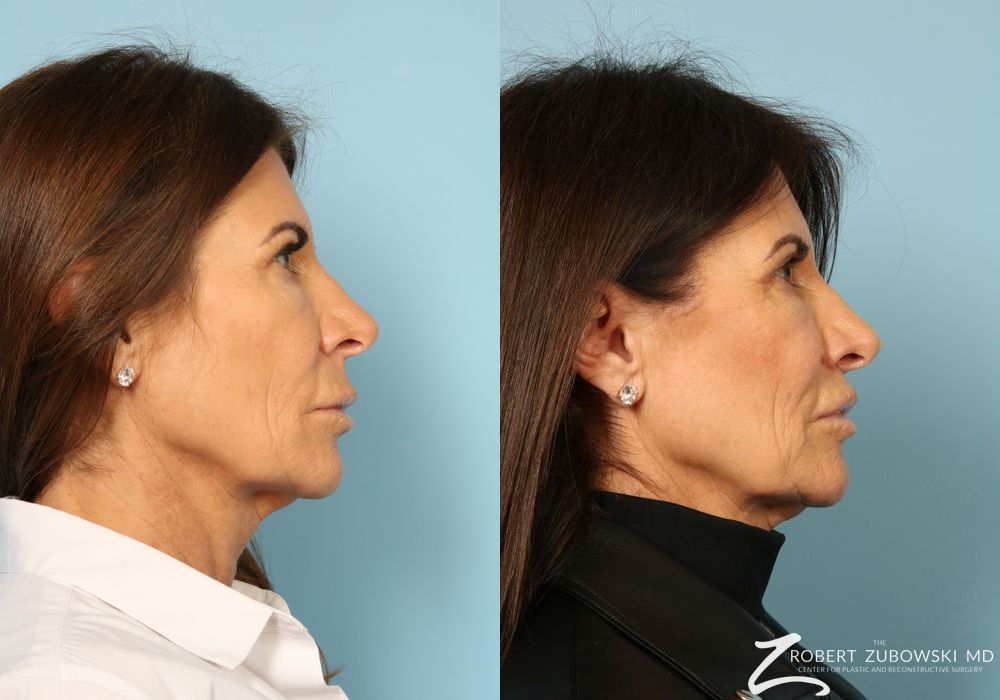 Before and after Lip Augmentation case 8563 - Angle 2