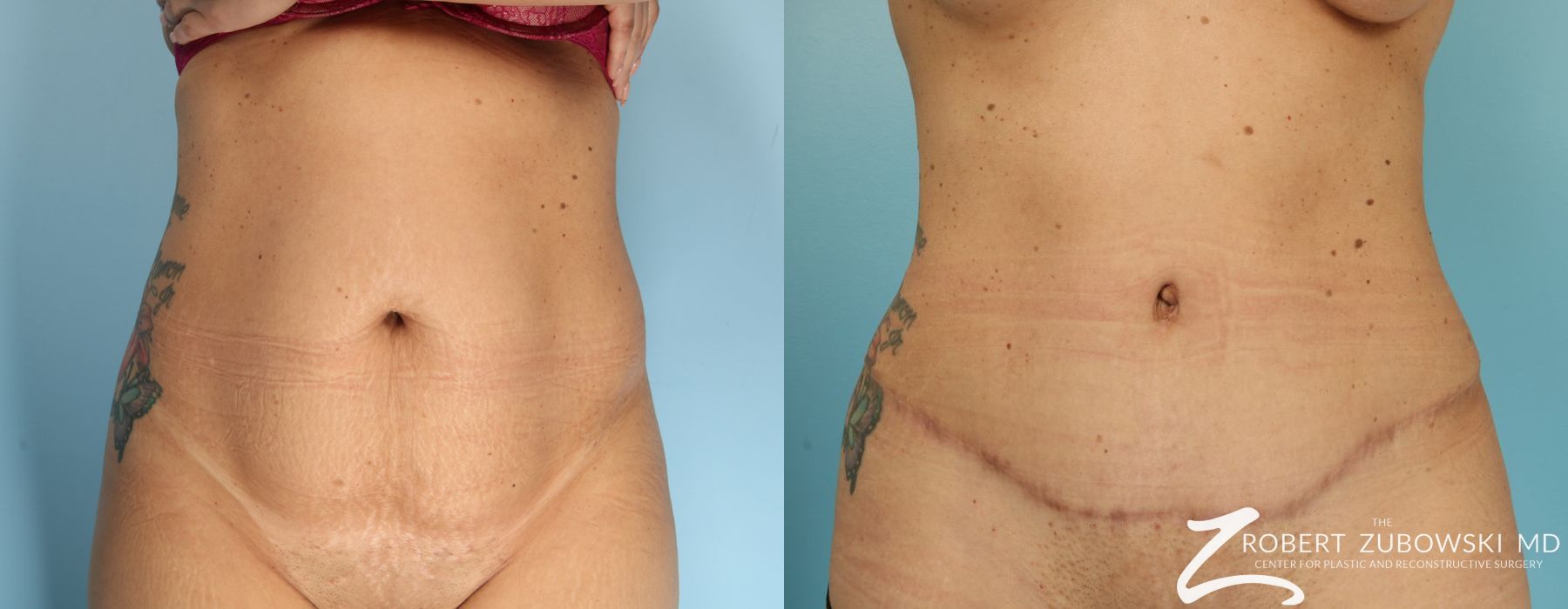 Lipoabdominoplasty - Case 4381