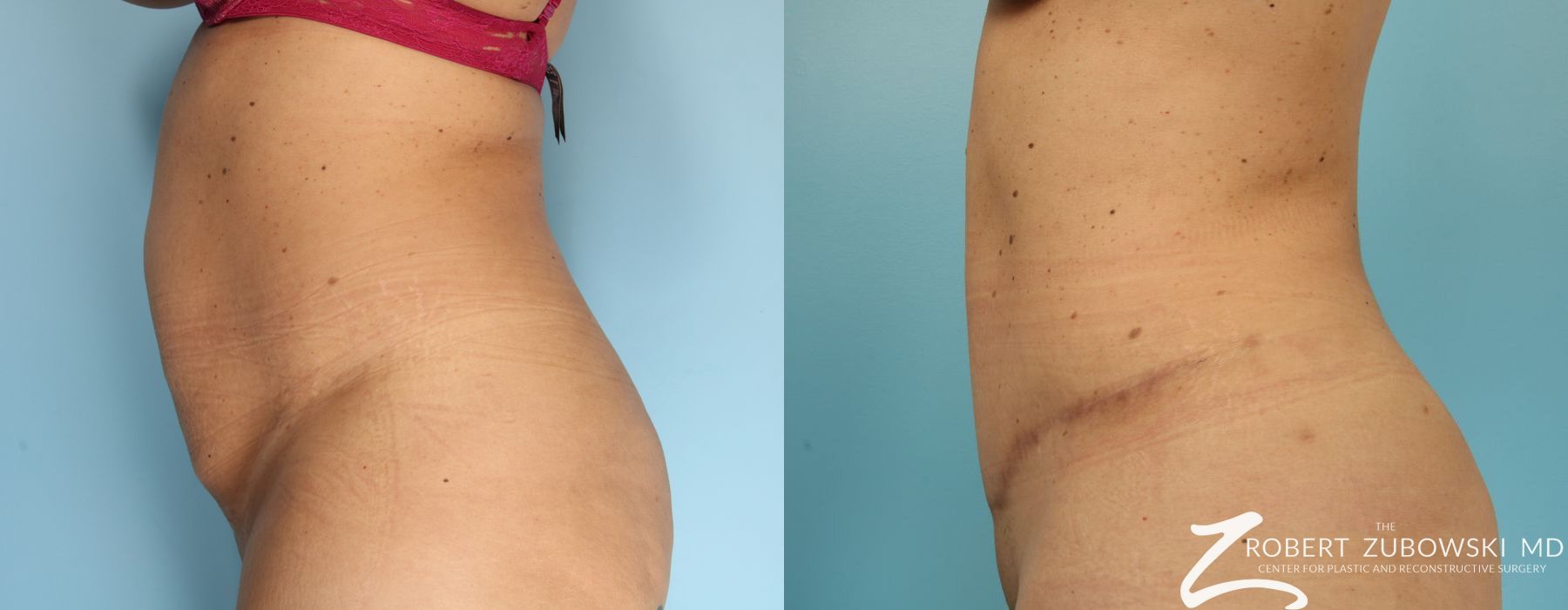 Lipoabdominoplasty - Thumbnail 2