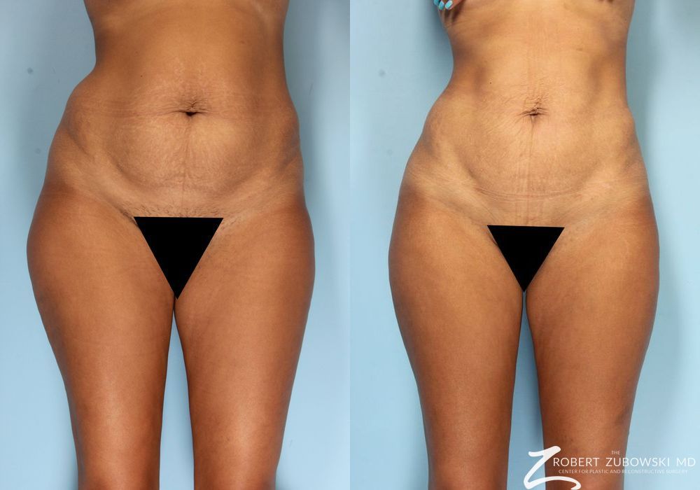 Liposuction - Case 3571