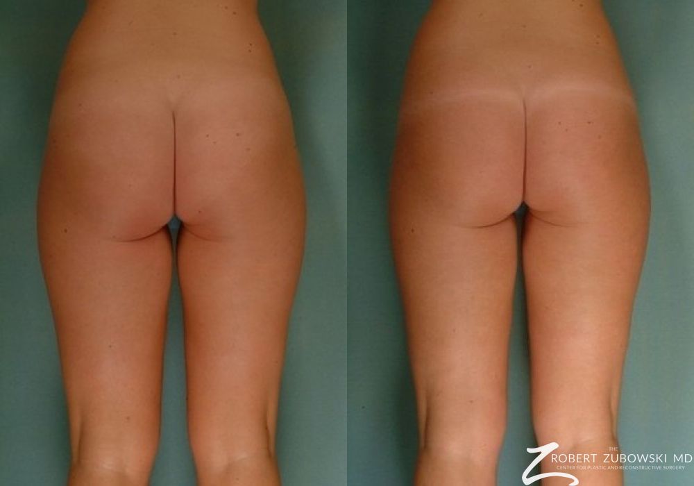 Liposuction - Thumbnail 2