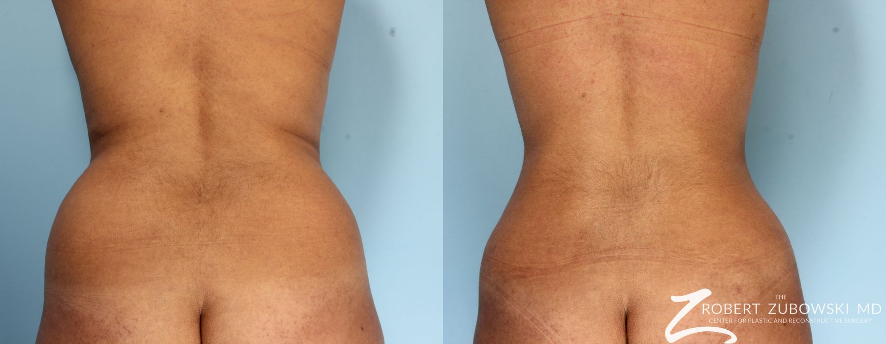 Liposuction - Thumbnail 2