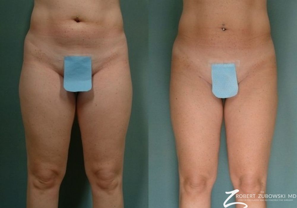 Liposuction - Case 3525