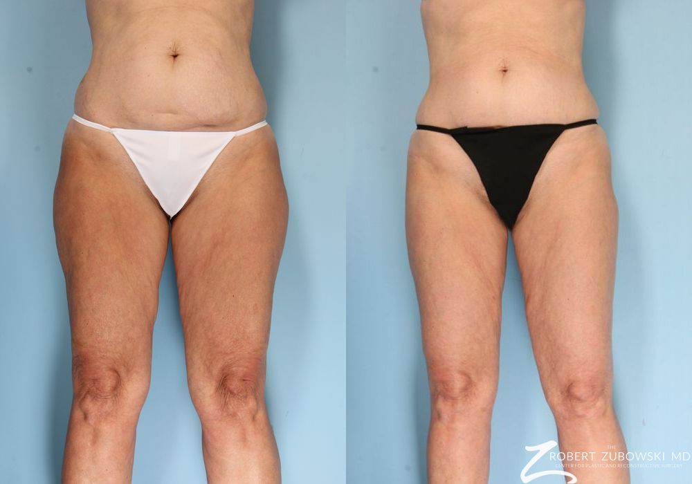 Liposuction - Case 3568