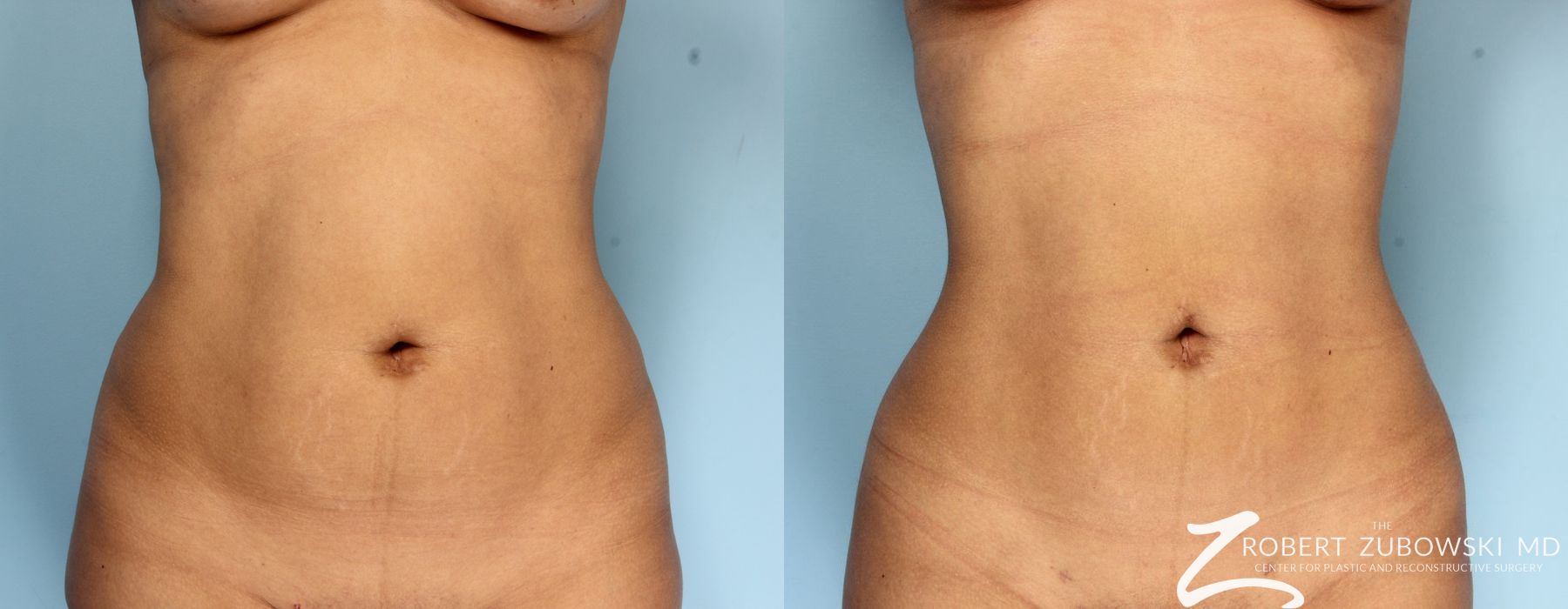 Liposuction - Case 3566