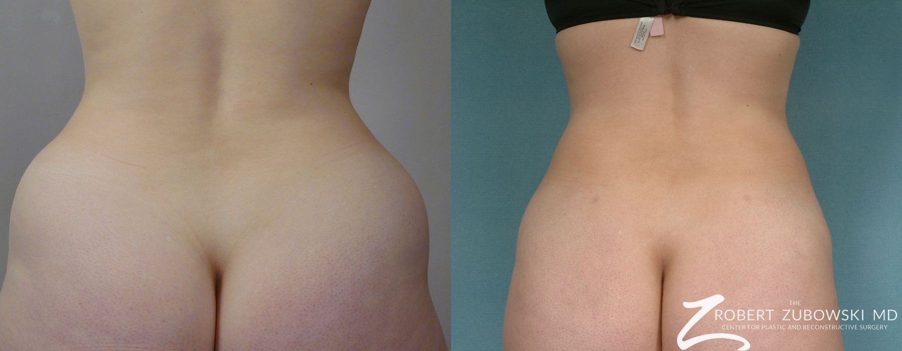 Liposuction - Thumbnail 6