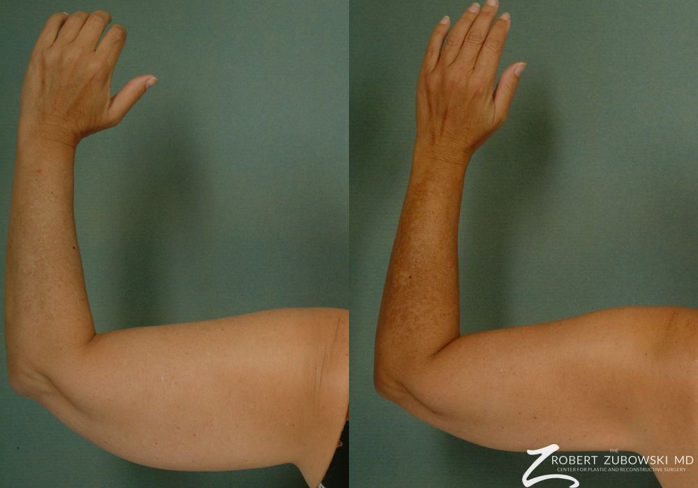 Liposuction - Thumbnail 2