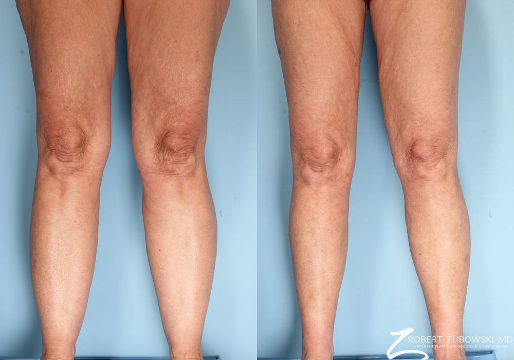 Liposuction - Thumbnail 2