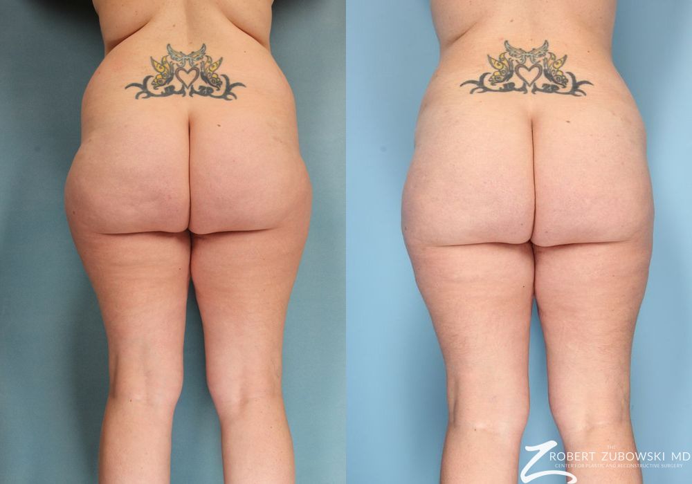 Liposuction - Case 3538