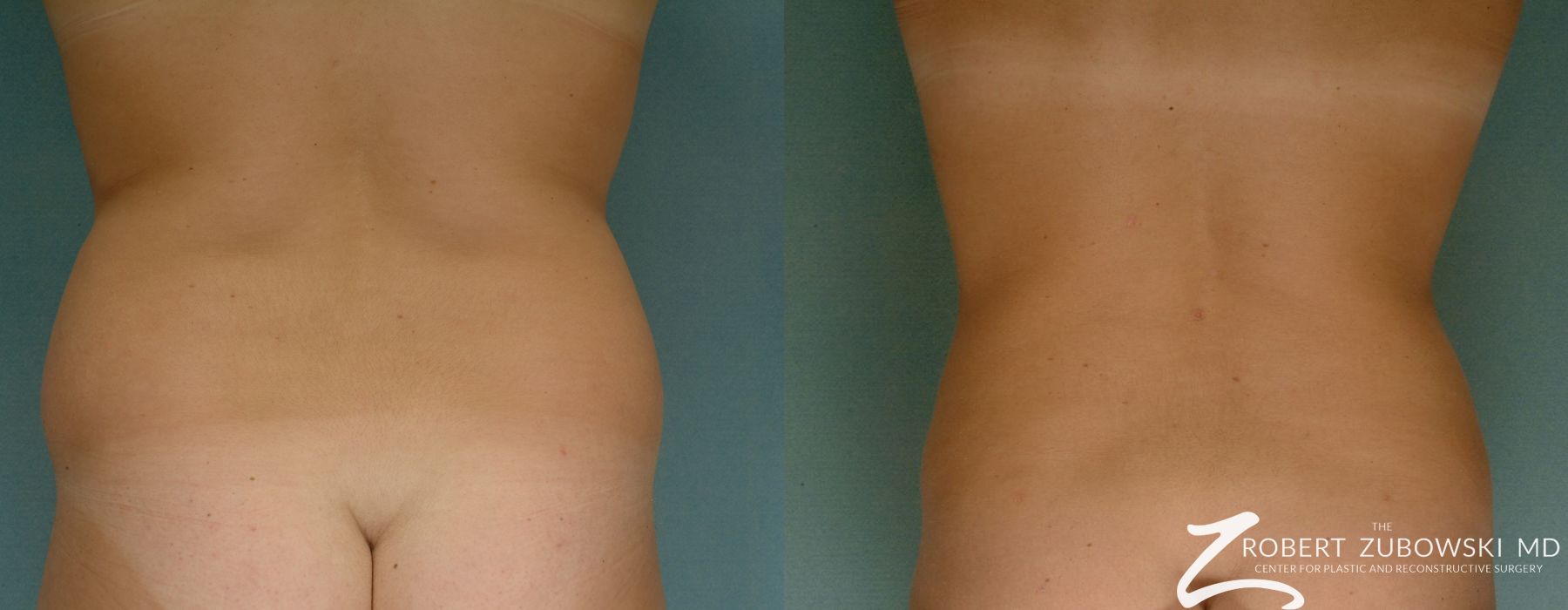 Liposuction - Thumbnail 3