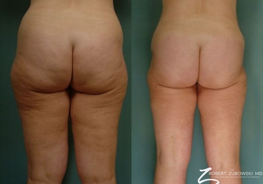 Liposuction - Thumbnail 2